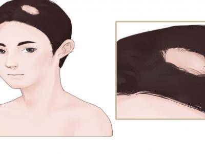 性生活頻繁會加重脫發 脫發的原因有哪些