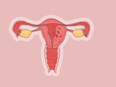 什么是腺肌病有什么癥狀 腺肌病可以用中藥調理好嗎