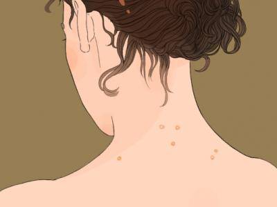 尖銳濕疣的癥狀檢測方法是什么？確診尖銳濕疣的5個診斷方法