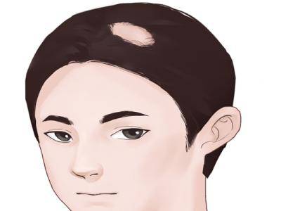 如何預(yù)防因雄激素引起的脫發(fā) 雄激素引起的脫發(fā)怎么辦