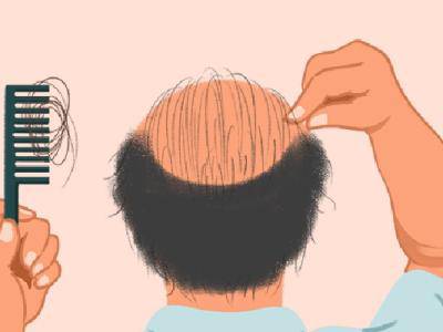 脂溢性脫發(fā)的原因是什么 脂溢性脫發(fā)有效的防治措施