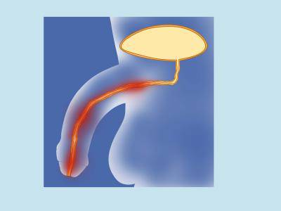 男性尿道炎有哪些類型 男性尿道炎的癥狀是什么