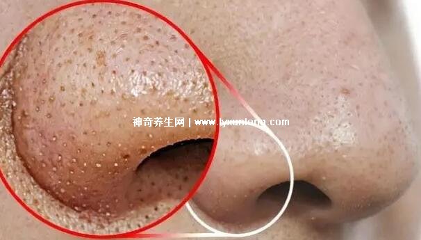 閉口粉刺真正的圖片，粗糙的顆粒會發炎長膿皰(黑頭也是粉刺)