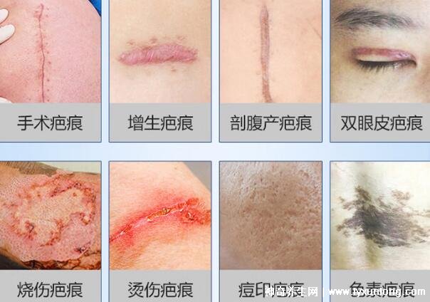 去疤痕最好的十大藥膏，疤克上榜強推康瑞保(3年內的疤都能祛)
