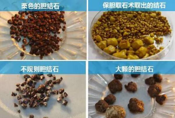 三個動作排出膽結石，肩橋/腰部扭轉/前傾動作促排結石
