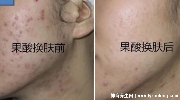 果酸換膚多少錢一次，1000-3000元不等(細致毛孔/淡化痘印)