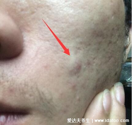 暗瘡圖片是什么樣子，暗瘡和痤瘡有區別(不形成膿包)