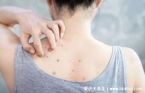 暗瘡圖片是什么樣子，暗瘡和痤瘡有區別(不形成膿包)