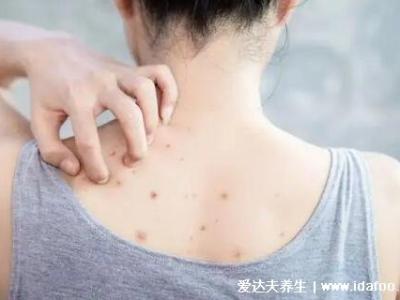 暗瘡圖片是什么樣子，暗瘡和痤瘡有區(qū)別(不形成膿包)