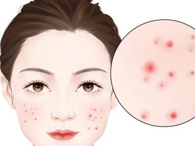 果酸祛痘做幾次才有效 果酸換膚的危害