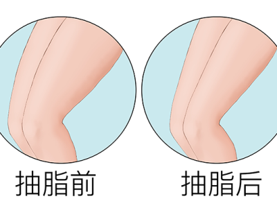 節食減肥好還是抽脂好