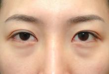  為什么會出現眼袋？怎樣有效去眼袋？