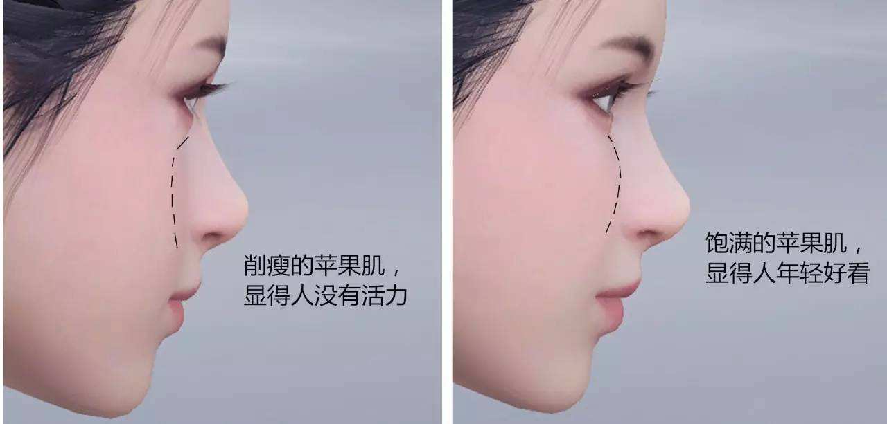 為什么蘋果肌填充之后 臉部顯著不自然？