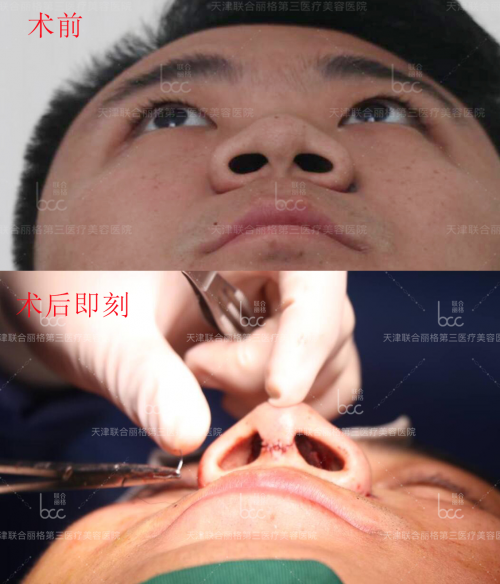 關于『 萌芽仿生綜合隆鼻術』你想知道的都在這里! 關于『 萌芽仿生綜合隆鼻術』你想知道的都在這里!