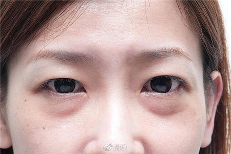抬頭紋顯老把你顏值拉低，五個有效改善抬頭紋的方法