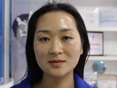 玻尿酸原液的作用和使用方法，女性天天用玻尿酸的后果