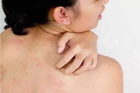 后背長痘痘是什么原因，女生后背祛痘最有效的方法