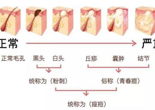 臉上長(zhǎng)痘痘怎么調(diào)理?做好這三點(diǎn)讓痘痘遠(yuǎn)離你-易網(wǎng)健康<a href=http://www.aoa7937.com/jkys/ target=_blank class=infotextkey>養(yǎng)生</a>網(wǎng) 臉上長(zhǎng)痘痘怎么調(diào)理?做好這三點(diǎn)讓痘痘遠(yuǎn)離你