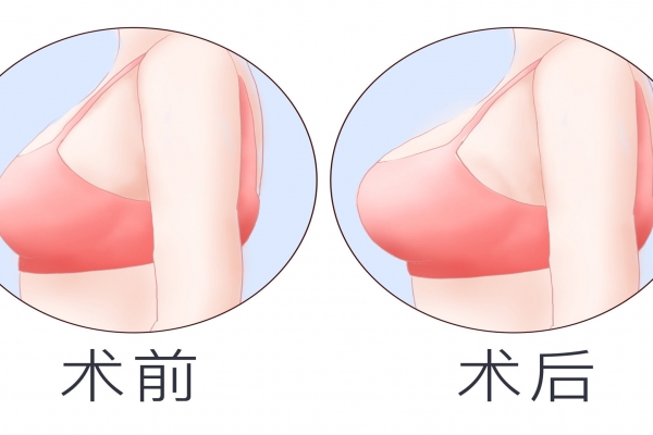 整形隆胸手術(shù)好不好