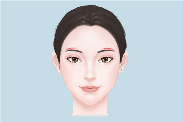 筋膜提升和線雕有什么不一樣-易網(wǎng)<a href=http://www.aoa7937.com/ target=_blank class=infotextkey>健康養(yǎng)生</a>網(wǎng) 筋膜提升和線雕有什么不一樣