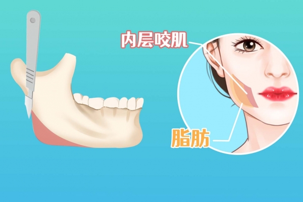 怎樣消除咬肌