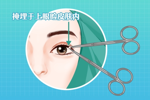 雙眼皮太寬了怎么修復(fù)