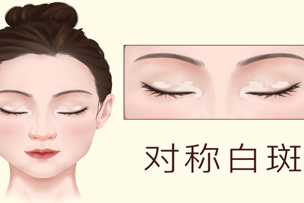 皮膚白斑