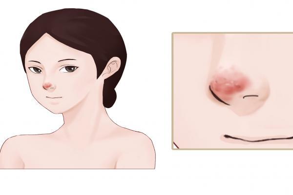 草莓鼻子怎么去掉還能縮小毛孔-易網健康<a href=http://www.aoa7937.com/jkys/ target=_blank class=infotextkey>養生</a>網 草莓鼻子怎么去掉還能縮小毛孔