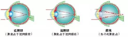 關于散光，這些你都了解嗎？