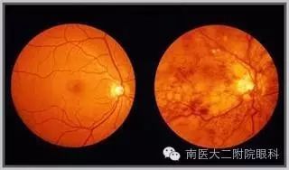 高血壓病人易出現(xiàn)眼底出血 高血壓病人易出現(xiàn)眼底出血