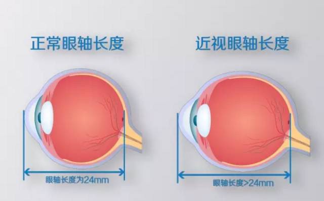 近視不可怕，度數(shù)越來(lái)越深才可怕