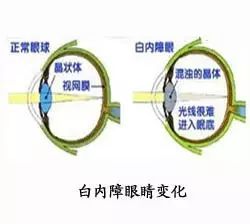 白內障初期的六大警報，五類高發人群