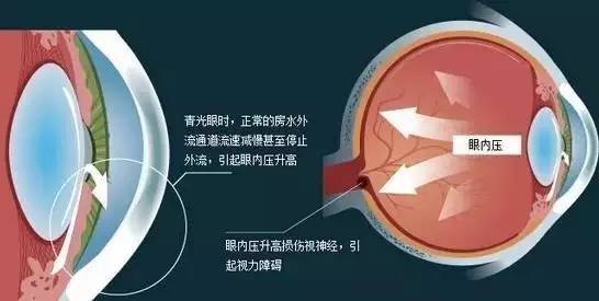 青光眼的三個(gè)危險(xiǎn)級(jí)別，你了解嗎？