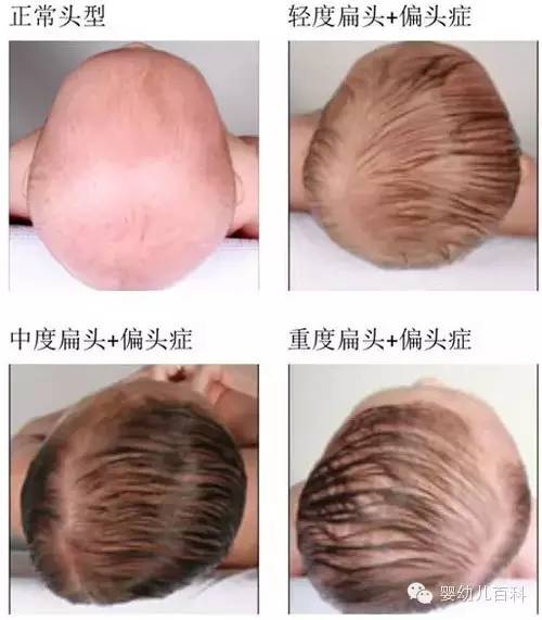 孩子的頭型與睡枕頭有關系嗎？