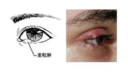 孩子長針眼怎么辦？