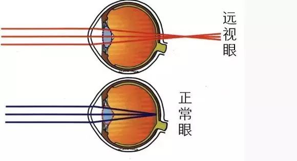 詳解近視、散光、遠視、斜視及弱視
