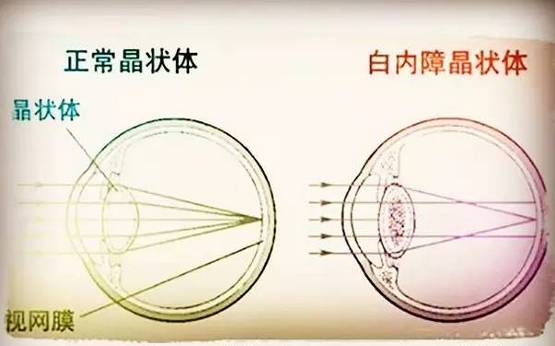 年輕時高度近視，以后會不會瞎？