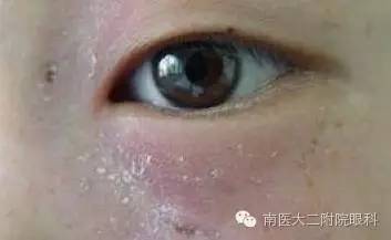 兒童兒淚囊炎的三種發病原因 兒童兒淚囊炎的三種發病原因