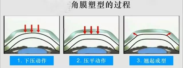 孩子近視又加深了怎么辦？