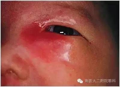 兒童兒淚囊炎的三種發病原因 兒童兒淚囊炎的三種發病原因