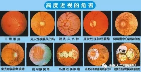 高度近視患者注意六大事項