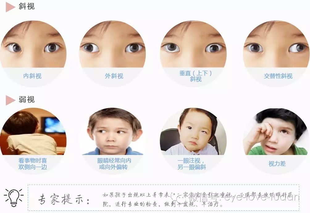 孩子斜弱視治療,不要錯(cuò)過(guò)關(guān)鍵時(shí)機(jī) 孩子斜弱視治療,不要錯(cuò)過(guò)關(guān)鍵時(shí)機(jī)