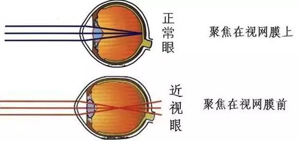 瞇眼睛真的能看的更清楚嗎？