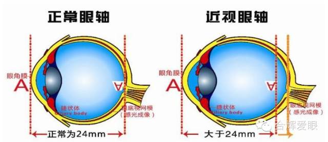 眼鏡戴久了，眼睛會變形嗎？