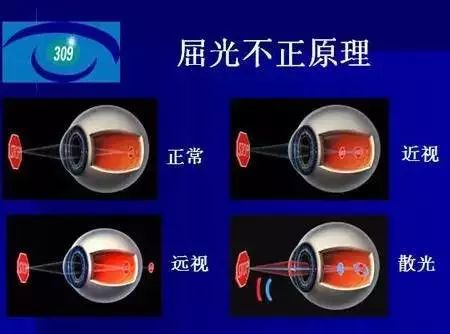 弱視是怎么形成的？它與近視有哪些區(qū)別？