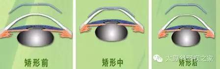 孩子度數持續增長怎么辦？