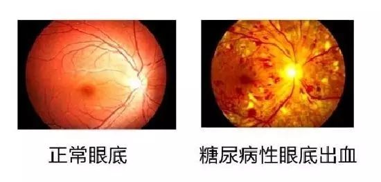 糖尿病會導致眼睛失明，視力模糊是前期征兆！