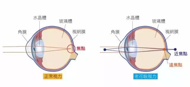 都是視力下降！白內(nèi)障、老花眼有何不同？
