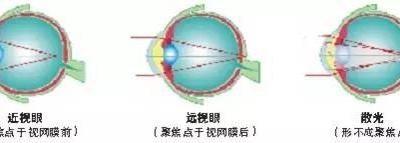 關(guān)于散光，這些你都了解嗎？