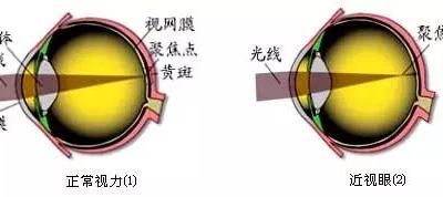 詳解近視、散光、遠(yuǎn)視、斜視及弱視